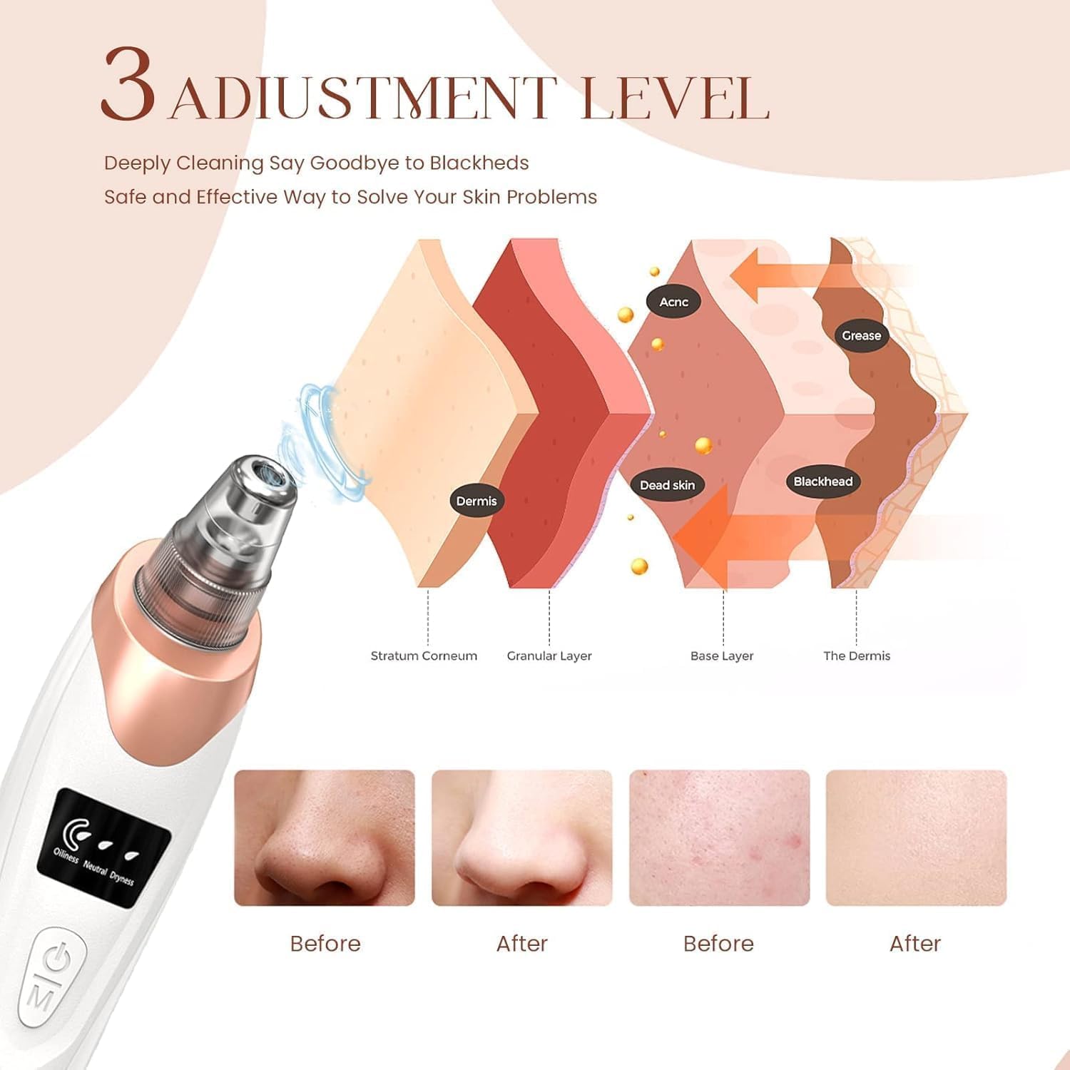 Blackhead vacuum tool in use on nose — gentle suction removing pore impurities safely